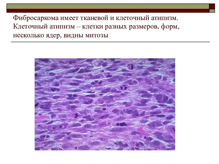 Фибросаркома имеет тканевой и клеточный атипизм. Клеточный атипизм – клетки разных