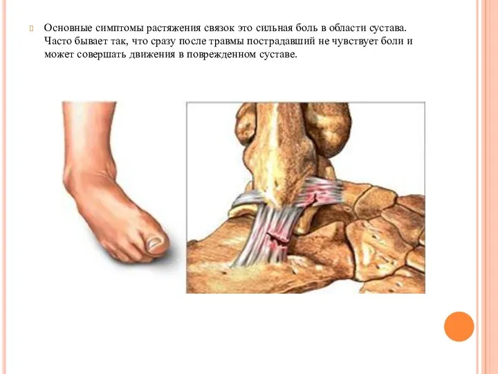 Основные симптомы растяжения связок это сильная боль в области сустава. Часто