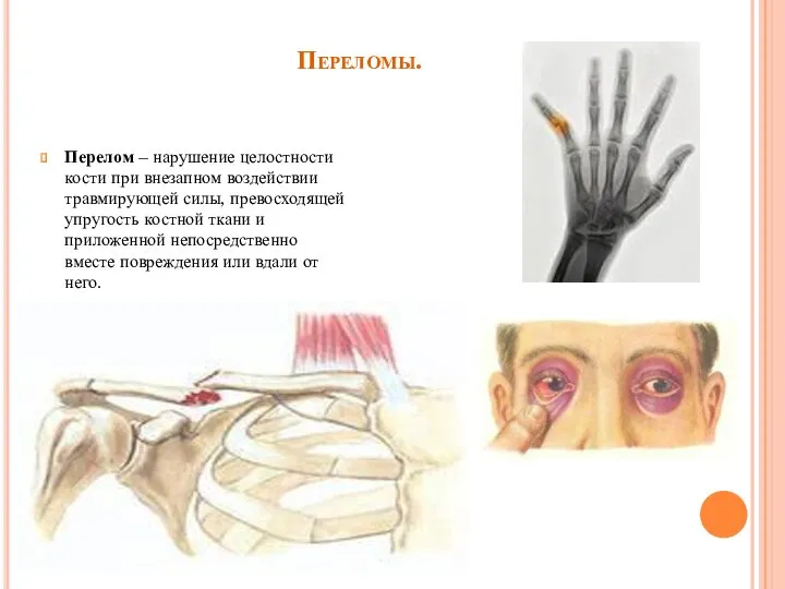 Переломы. Перелом – нарушение целостности кости при внезапном воздействии травмирующей силы,