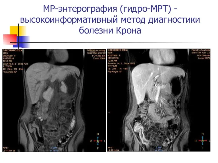 МР-энтерография (гидро-МРТ) - высокоинформативный метод диагностики болезни Крона