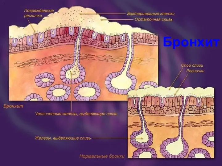 Бронхит Бронхит