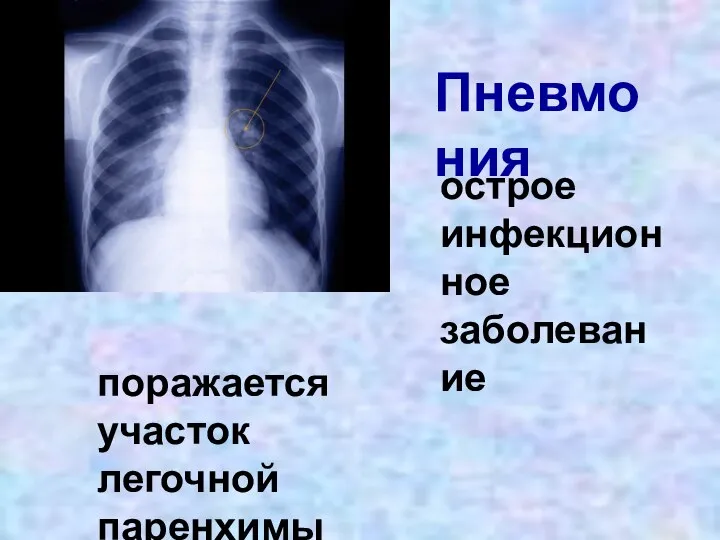 Пневмония острое инфекционное заболевание поражается участок легочной паренхимы