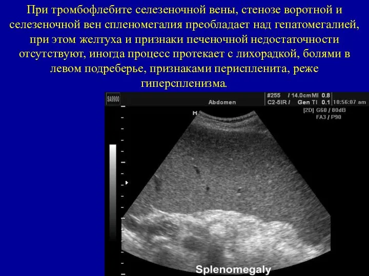 При тромбофлебите селезеночной вены, стенозе воротной и селезеночной вен спленомегалия преобладает