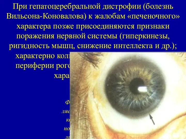 При гепатоцеребральной дистрофии (болезнь Вильсона-Коновалова) к жалобам «печеночного» характера позже присоединяются