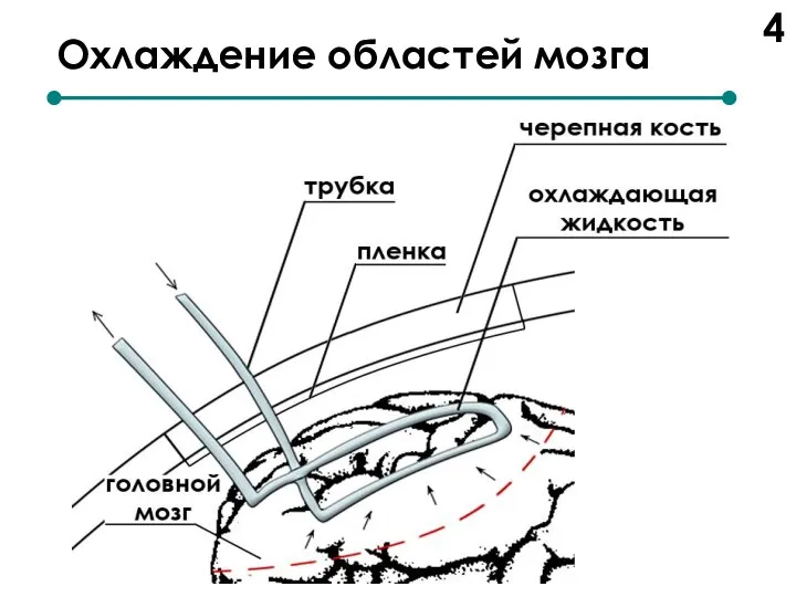 Охлаждение областей мозга 4