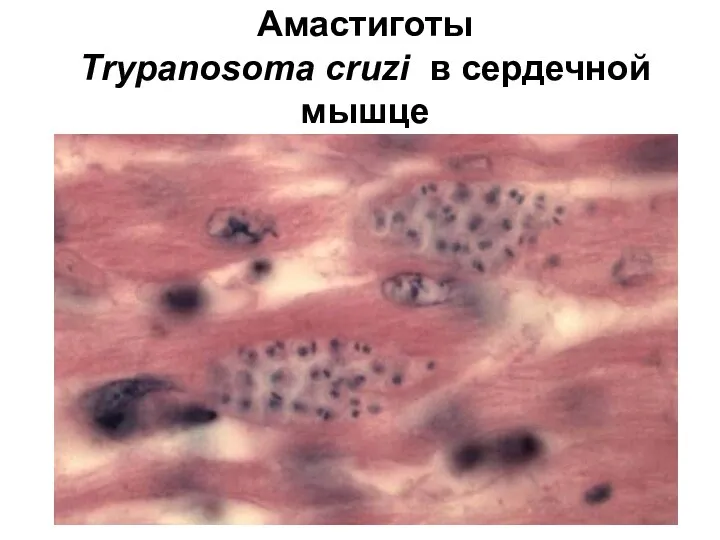 Амастиготы Тrypanosoma cruzi в сердечной мышце