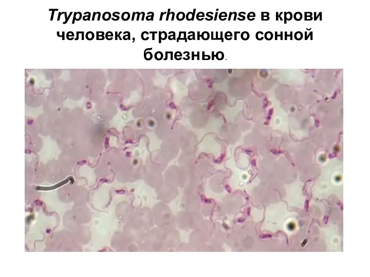 Trypanosoma rhodesiense в крови человека, страдающего сонной болезнью.