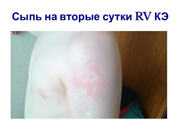 Сыпь на вторые сутки RV КЭ