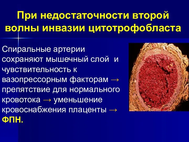 При недостаточности второй волны инвазии цитотрофобласта Спиральные артерии сохраняют мышечный слой