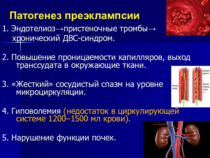 Патогенез преэклампсии 1. Эндотелиоз→пристеночные тромбы→ хронический ДВС-синдром. 2. Повышение проницаемости капилляров,