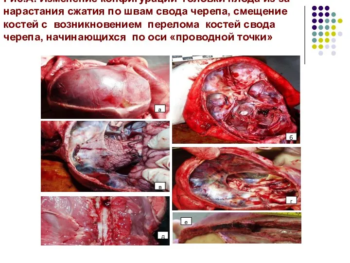 Рис.А. Изменение конфигурации головки плода из-за нарастания сжатия по швам свода