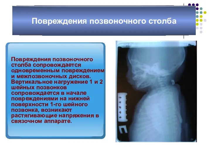 Повреждения позвоночного столба Повреждения позвоночного столба сопровождается одновременным повреждением и межпозвоночных