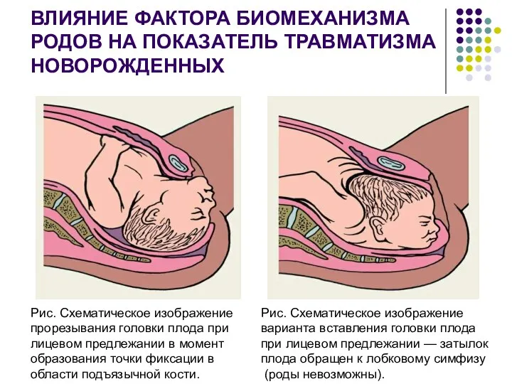 ВЛИЯНИЕ ФАКТОРА БИОМЕХАНИЗМА РОДОВ НА ПОКАЗАТЕЛЬ ТРАВМАТИЗМА НОВОРОЖДЕННЫХ Рис. Схематическое изображение