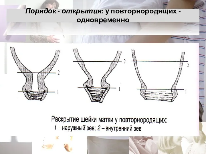 Порядок - открытия: у повторнородящих - одновременно