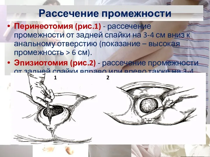 Перинеотомия (рис.1) - рассечение промежности от задней спайки на 3-4 см