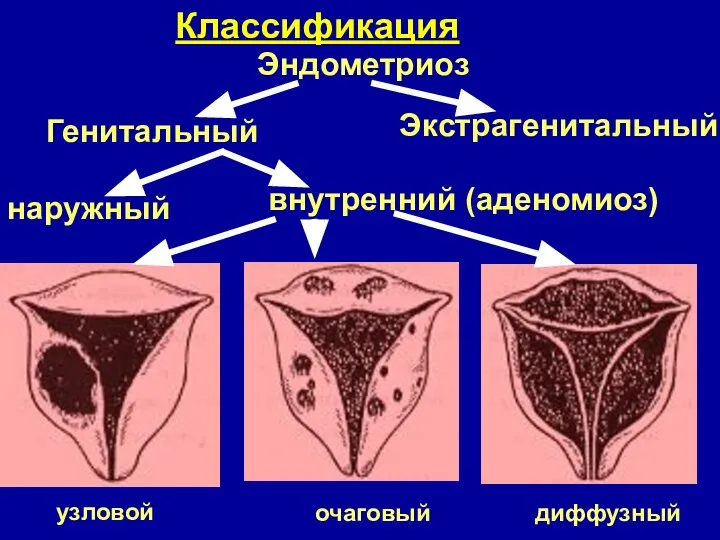 Классификация Эндометриоз Экстрагенитальный внутренний (аденомиоз) Генитальный наружный
