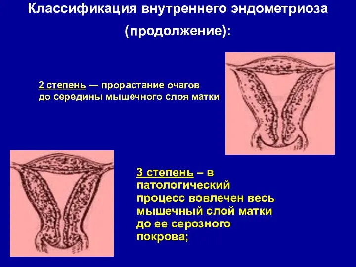 Классификация внутреннего эндометриоза (продолжение): 3 степень – в патологический процесс вовлечен