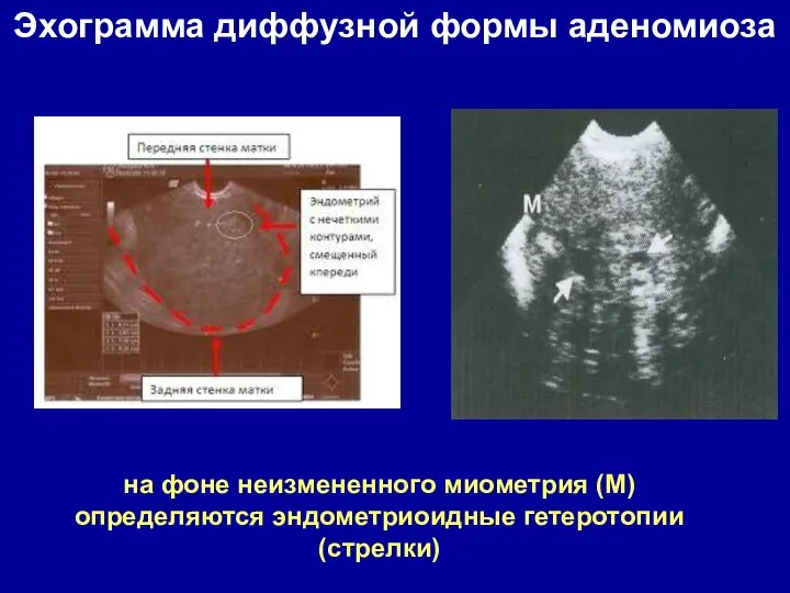 на фоне неизмененного миометрия (М) определяются эндометриоидные гетеротопии (стрелки) Эхограмма диффузной формы аденомиоза