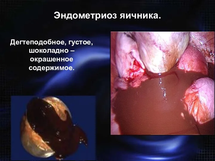 Эндометриоз яичника. Дегтеподобное, густое, шоколадно – окрашенное содержимое. Точность диагностики эндометриом при лапароскопии – 98-100%
