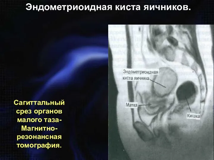 Сагиттальный срез органов малого таза- Магнитно-резонансная томография. Эндометриоидная киста яичников.