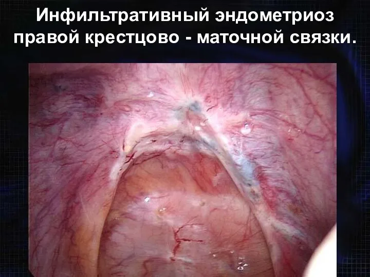 Инфильтративный эндометриоз правой крестцово - маточной связки.