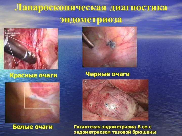 Красные очаги Черные очаги Белые очаги Лапароскопическая диагностика эндометриоза Гигантская эндометриома