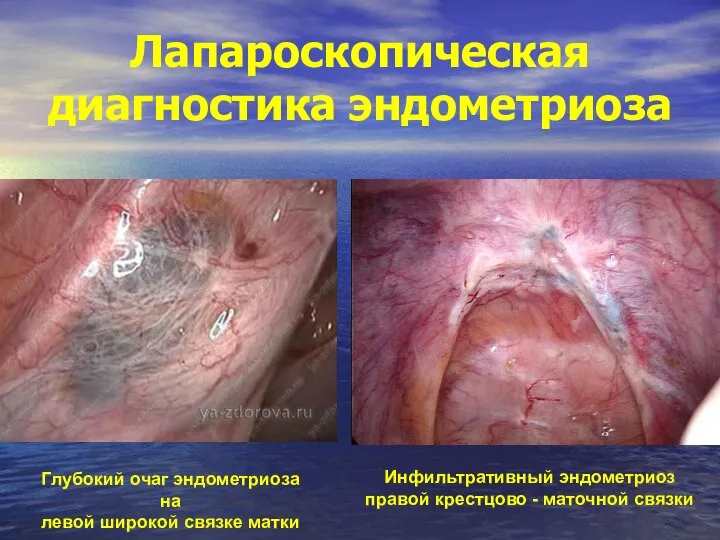 Лапароскопическая диагностика эндометриоза Инфильтративный эндометриоз правой крестцово - маточной связки Глубокий