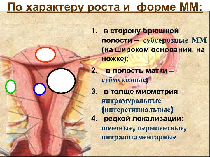 в сторону брюшной полости – субсерозные ММ (на широком основании, на