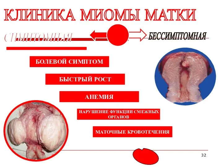 КЛИНИКА МИОМЫ МАТКИ СИМПТОМНАЯ БЕССИМПТОМНАЯ БОЛЕВОЙ СИМПТОМ БЫСТРЫЙ РОСТ АНЕМИЯ НАРУШЕНИЕ ФУНКЦИИ СМЕЖНЫХ ОРГАНОВ МАТОЧНЫЕ КРОВОТЕЧЕНИЯ