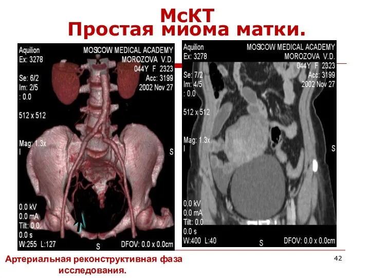 МсКТ Простая миома матки. Артериальная реконструктивная фаза исследования.