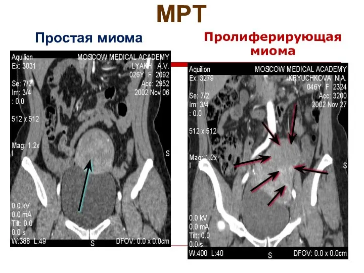 МРТ Простая миома Пролиферирующая миома