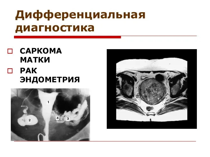 Дифференциальная диагностика САРКОМА МАТКИ РАК ЭНДОМЕТРИЯ