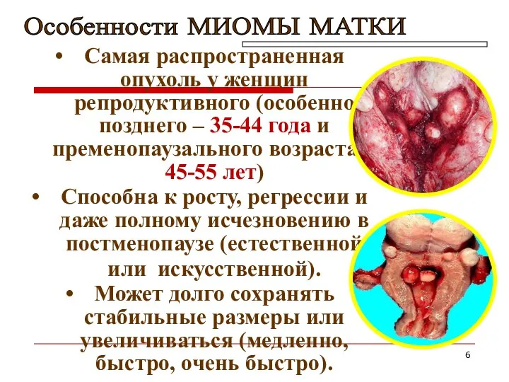 Самая распространенная опухоль у женщин репродуктивного (особенно позднего – 35-44 года