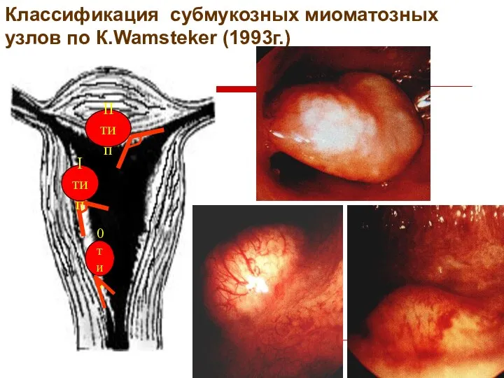 Классификация субмукозных миоматозных узлов по К.Wamsteker (1993г.)