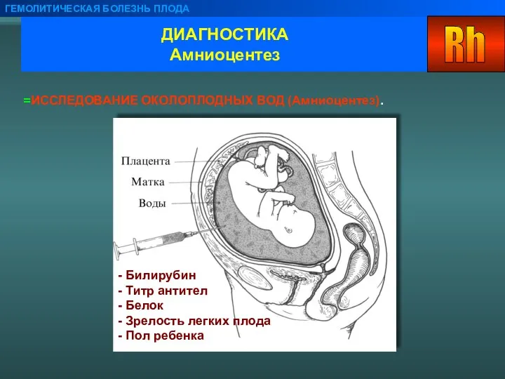 ДИАГНОСТИКА Амниоцентез ГЕМОЛИТИЧЕСКАЯ БОЛЕЗНЬ ПЛОДА ИССЛЕДОВАНИЕ ОКОЛОПЛОДНЫХ ВОД (Амниоцентез). - Билирубин