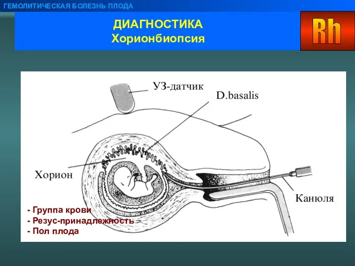 ДИАГНОСТИКА Хорионбиопсия ГЕМОЛИТИЧЕСКАЯ БОЛЕЗНЬ ПЛОДА - Группа крови - Резус-принадлежность - Пол плода