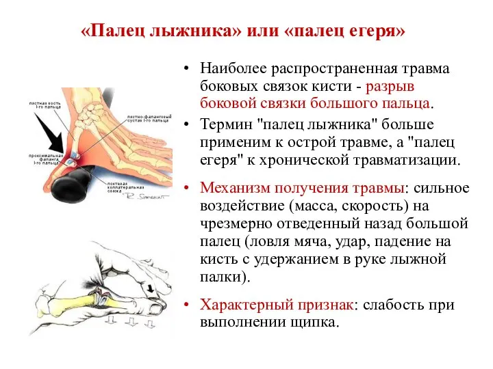 «Палец лыжника» или «палец егеря» Наиболее распространенная травма боковых связок кисти