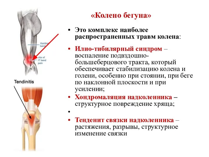 «Колено бегуна» Это комплекс наиболее распространенных травм колена: Илио-тибилярный синдром –