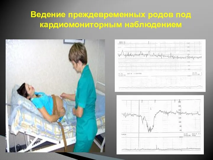 Ведение преждевременных родов под кардиомониторным наблюдением