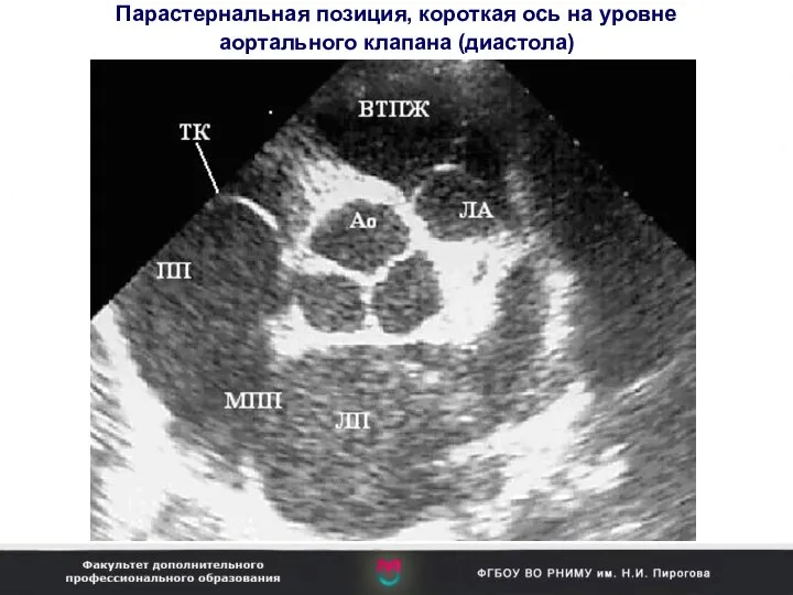 Парастернальная позиция, короткая ось на уровне аортального клапана (диастола)