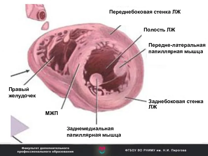 Переднебоковая стенка ЛЖ Полость ЛЖ Передне-латеральная папиллярная мышца Заднебоковая стенка ЛЖ