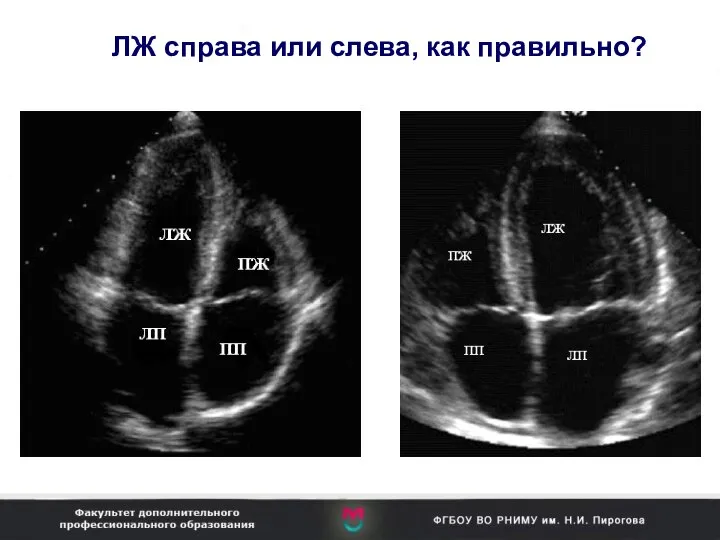 ЛЖ справа или слева, как правильно?