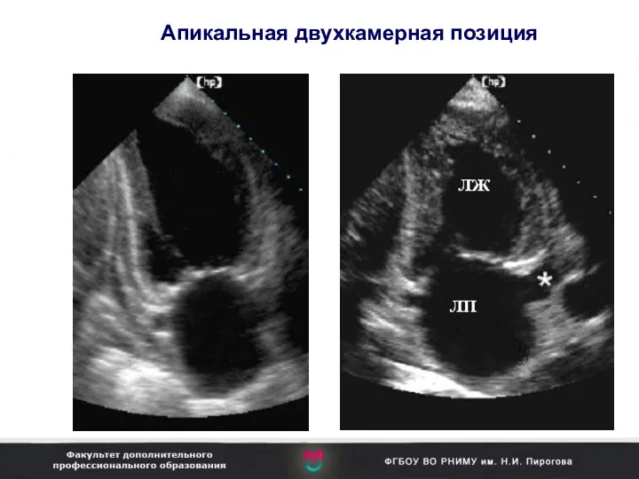 Апикальная двухкамерная позиция