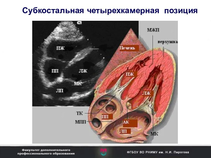 Субкостальная четырехкамерная позиция