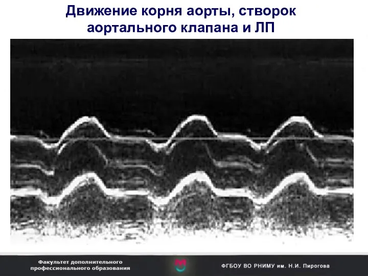 Движение корня аорты, створок аортального клапана и ЛП