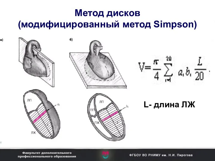 Метод дисков (модифицированный метод Simpson) L- длина ЛЖ