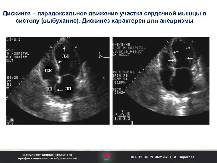 Дискинез – парадоксальное движение участка сердечной мышцы в систолу (выбухание). Дискинез характерен для аневризмы