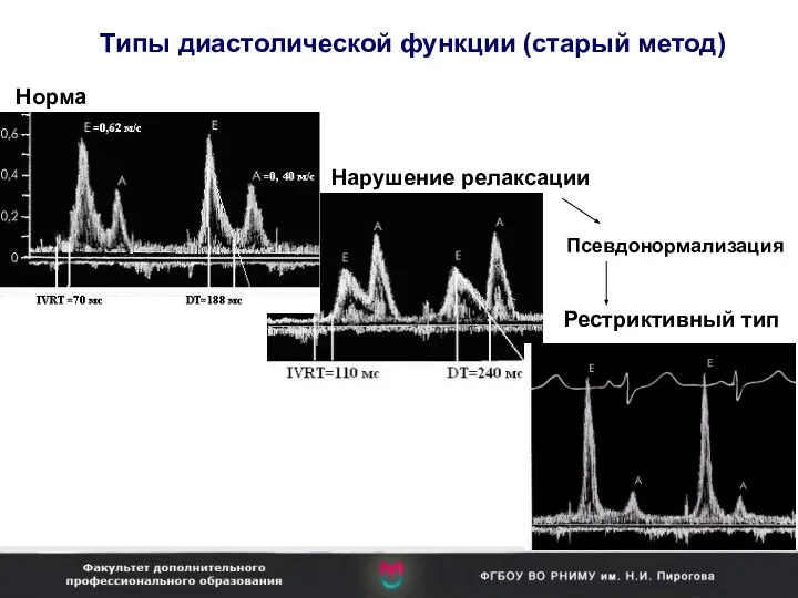 Типы диастолической функции (старый метод) Норма Нарушение релаксации Рестриктивный тип Псевдонормализация