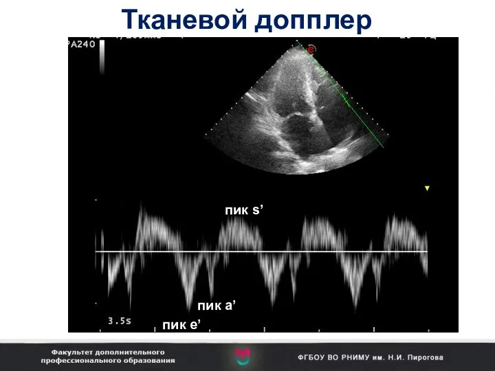 Тканевой допплер пик s’ пик e’ пик a’