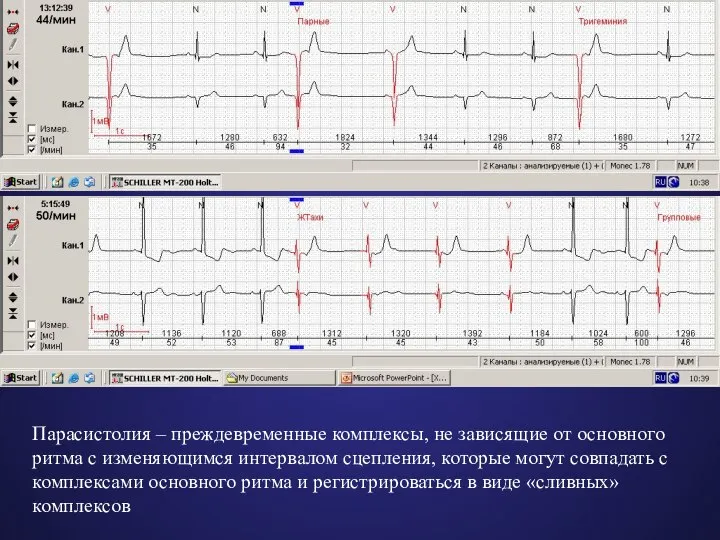 Парасистолия – преждевременные комплексы, не зависящие от основного ритма с изменяющимся